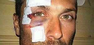 Paura per Ivan Basso. Cade in discesa, 15 punti di sutura sul viso